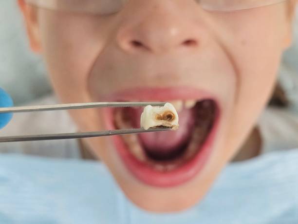 Best Emergency Dental Extractions in Carrollton, GA