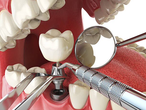 Best Broken or Cracked Tooth Emergency Dentist in Carrollton, GA